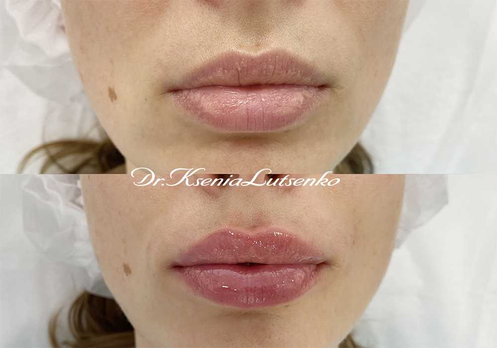 Увеличение губ, косметолог Ксения Луценко 101121  для статьи 